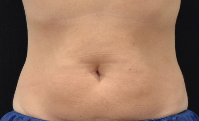 CoolSculpting Before & After Gallery - Patient 102583358 - Image 2