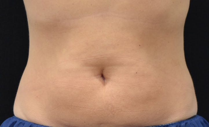 CoolSculpting in Long Island Before & After Photos