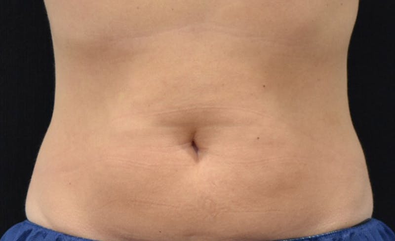 CoolSculpting Gallery - Patient 102583358 - Image 2