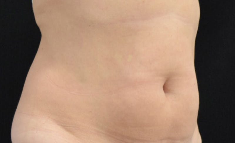CoolSculpting Gallery - Patient 102583358 - Image 3
