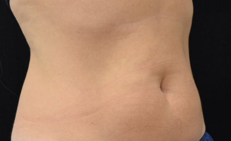 CoolSculpting Before & After Gallery - Patient 102583358 - Image 4