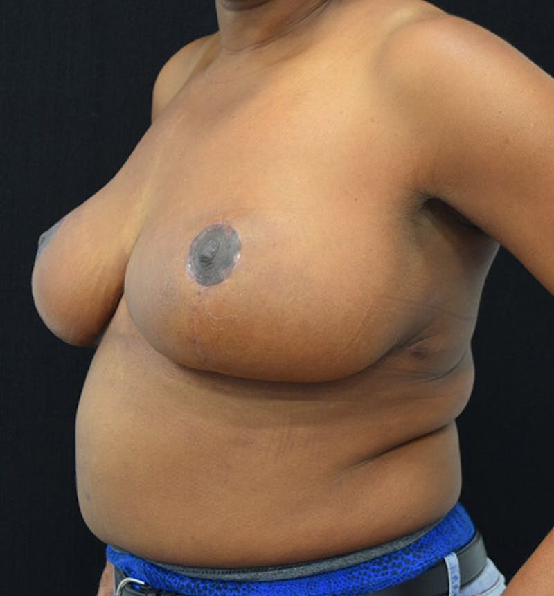 Breast Reduction Before & After Gallery - Patient 102583360 - Image 8