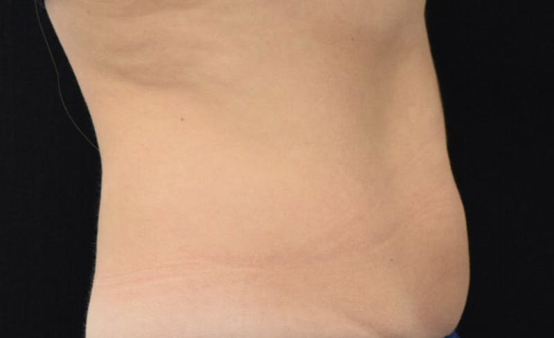 CoolSculpting Before & After Gallery - Patient 102583358 - Image 6