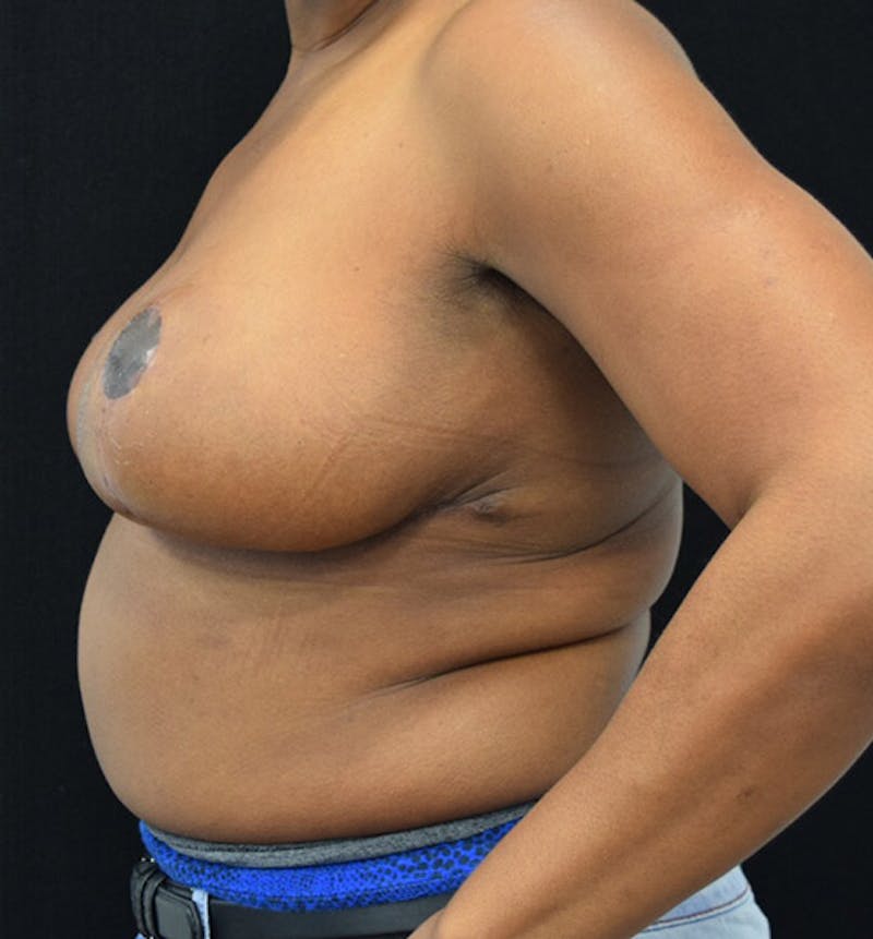 Breast Reduction Before & After Gallery - Patient 102583360 - Image 10
