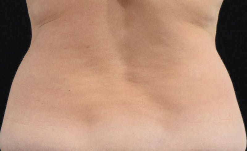 CoolSculpting Before & After Gallery - Patient 102583358 - Image 7