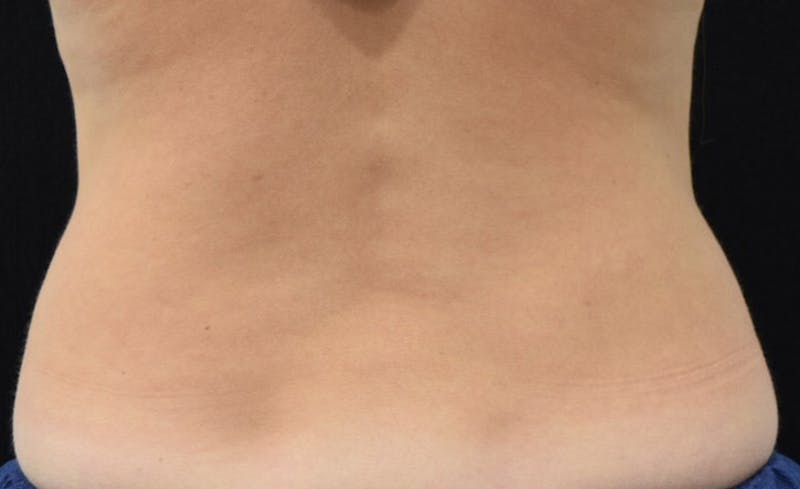 CoolSculpting Before & After Gallery - Patient 102583358 - Image 8