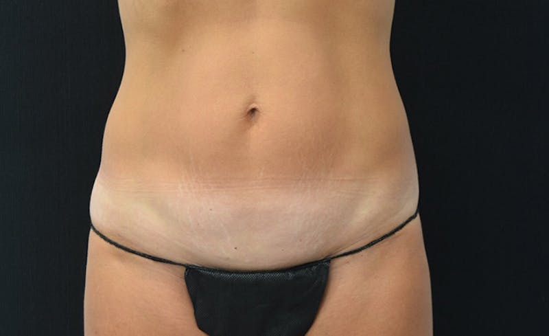 CoolSculpting Before & After Gallery - Patient 102583363 - Image 1