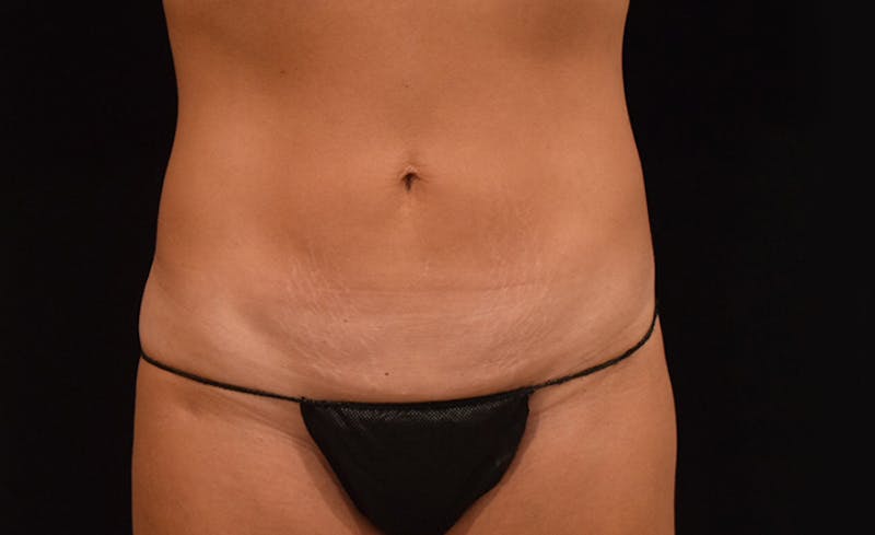 CoolSculpting Before & After Gallery - Patient 102583363 - Image 2