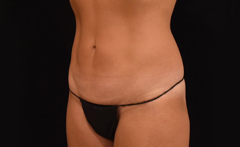 CoolSculpting Before & After Gallery - Patient 102583363 - Image 4