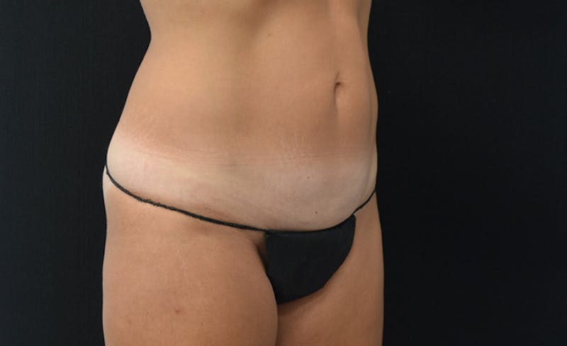 CoolSculpting Before & After Gallery - Patient 102583363 - Image 5