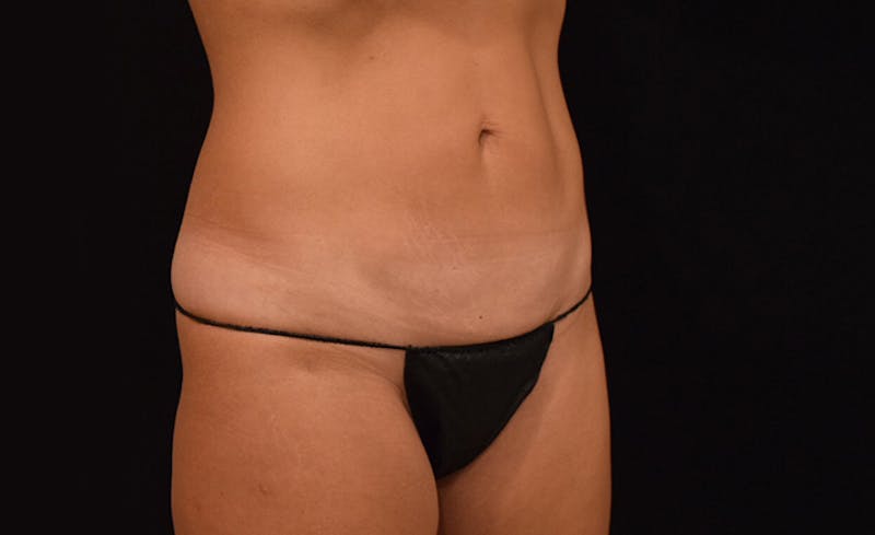 CoolSculpting Gallery - Patient 102583363 - Image 6