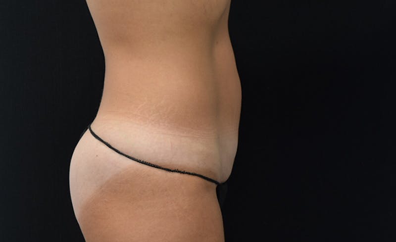 CoolSculpting Before & After Gallery - Patient 102583363 - Image 7