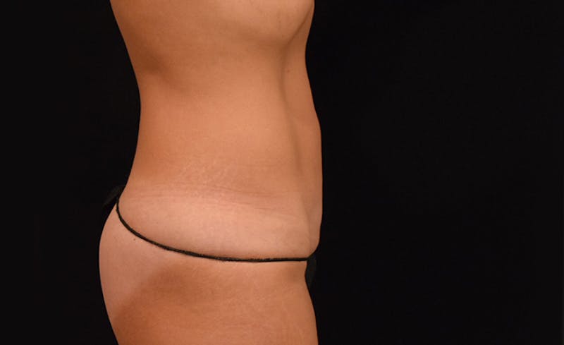 CoolSculpting Before & After Gallery - Patient 102583363 - Image 8