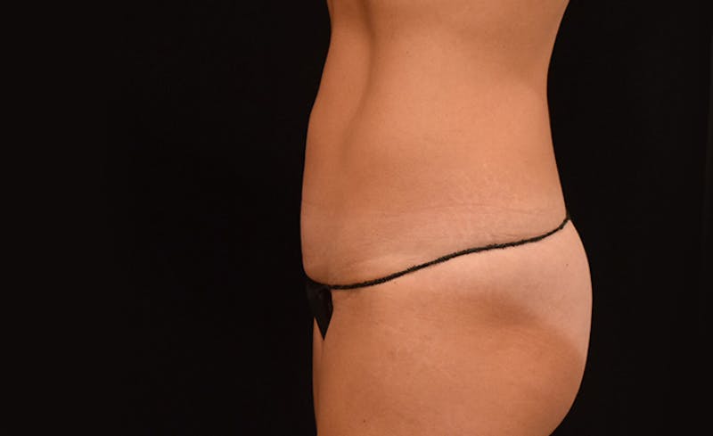 CoolSculpting Gallery - Patient 102583363 - Image 10
