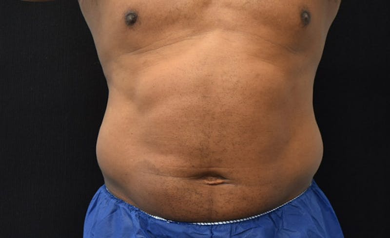 CoolSculpting Gallery - Patient 102583368 - Image 1