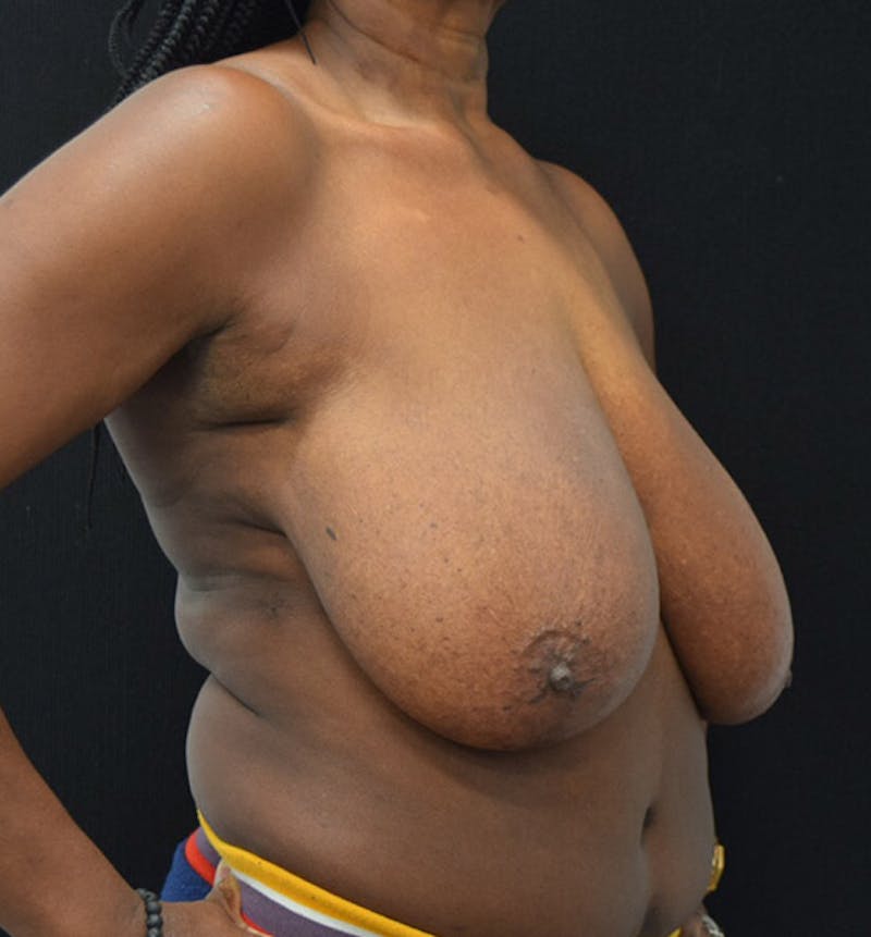 Breast Reduction Gallery - Patient 102583364 - Image 3