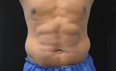 CoolSculpting Before & After Gallery - Patient 102583368 - Image 2