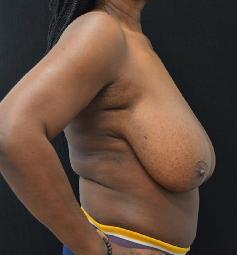 Breast Reduction Before & After Gallery - Patient 102583364 - Image 5