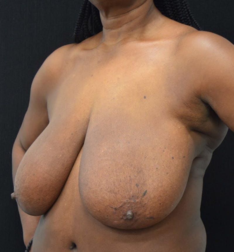 Breast Reduction Before & After Gallery - Patient 102583364 - Image 7