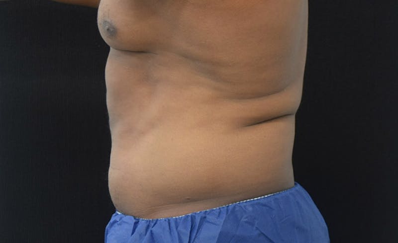 CoolSculpting Before & After Gallery - Patient 102583368 - Image 6