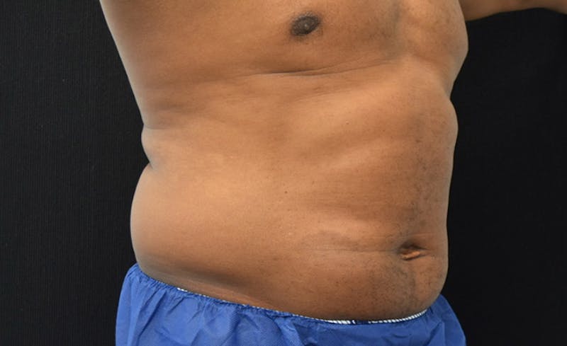 CoolSculpting Before & After Gallery - Patient 102583368 - Image 7