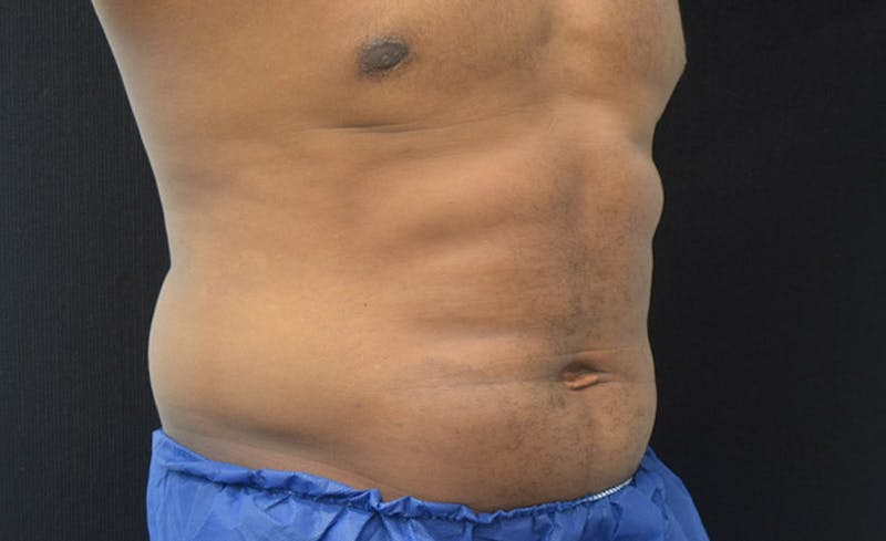 CoolSculpting Before & After Gallery - Patient 102583368 - Image 8