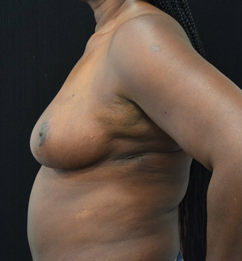 Breast Reduction Gallery - Patient 102583364 - Image 10