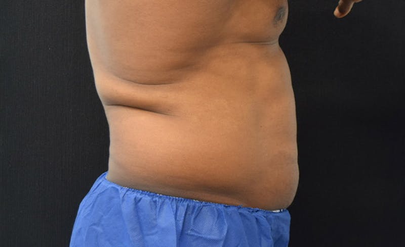 CoolSculpting Before & After Gallery - Patient 102583368 - Image 9