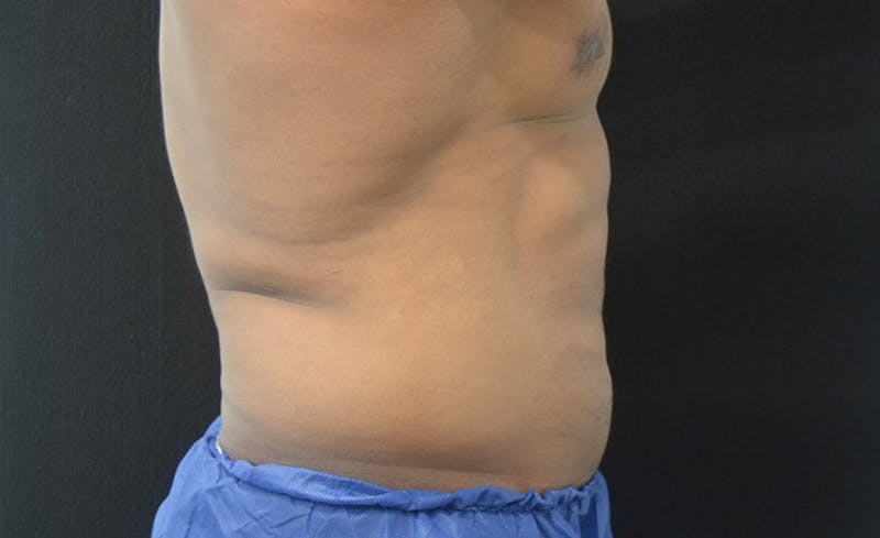 CoolSculpting Gallery - Patient 102583368 - Image 10