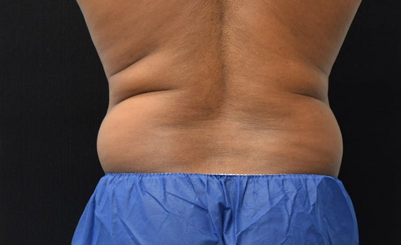 CoolSculpting Gallery - Patient 102583368 - Image 11