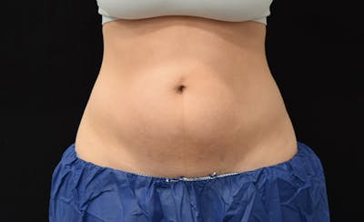 CoolSculpting Before & After Gallery - Patient 102583373 - Image 1
