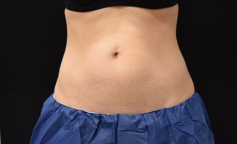 CoolSculpting Before & After Gallery - Patient 102583373 - Image 2