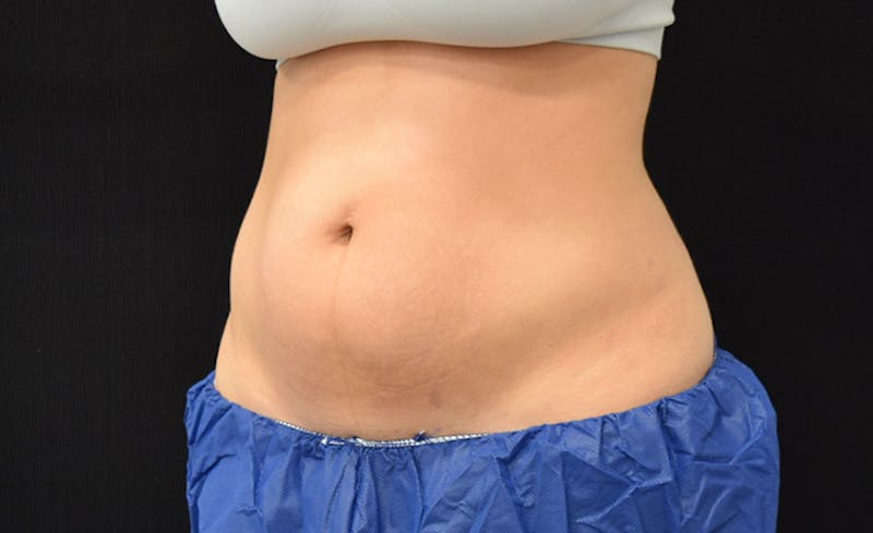 CoolSculpting Before & After Gallery - Patient 102583373 - Image 3