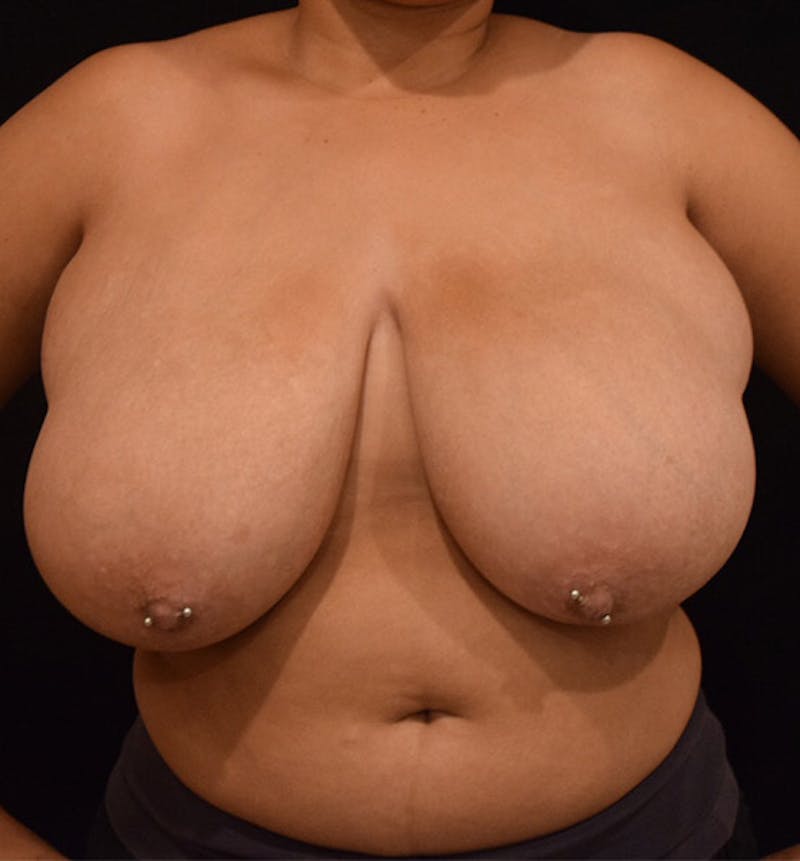 Breast Reduction Before & After Gallery - Patient 102583372 - Image 1