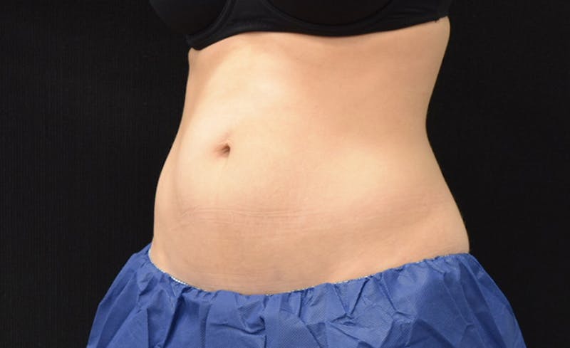 CoolSculpting Gallery - Patient 102583373 - Image 4
