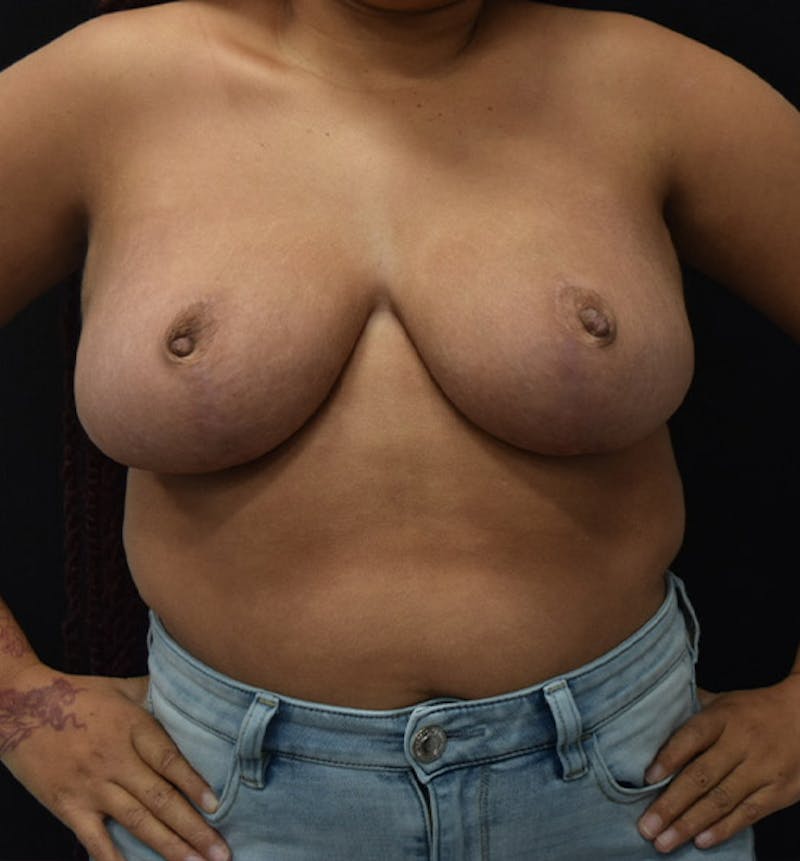 Breast Reduction Gallery - Patient 102583372 - Image 2