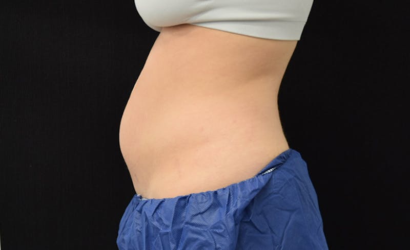 CoolSculpting Before & After Gallery - Patient 102583373 - Image 5
