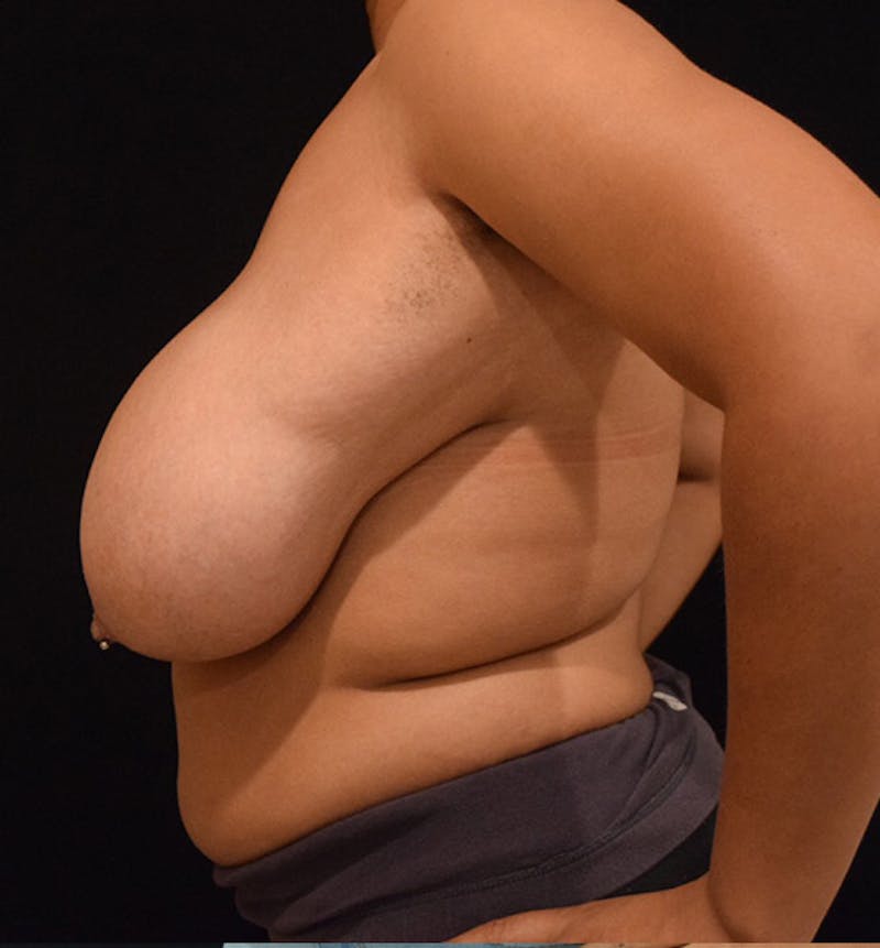 Breast Reduction Before & After Gallery - Patient 102583372 - Image 5
