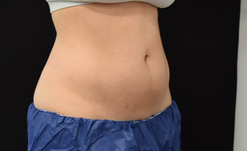 CoolSculpting Before & After Gallery - Patient 102583373 - Image 7