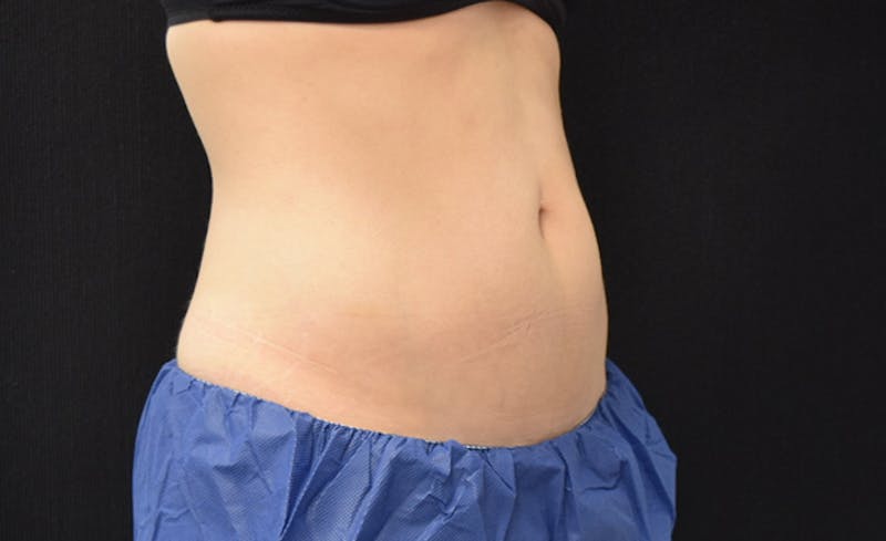 CoolSculpting Before & After Gallery - Patient 102583373 - Image 8