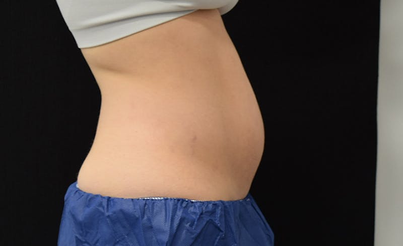 CoolSculpting Gallery - Patient 102583373 - Image 9