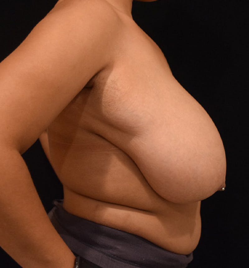 Breast Reduction Gallery - Patient 102583372 - Image 9