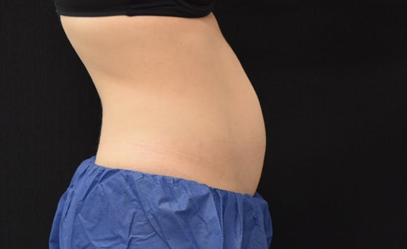 CoolSculpting Before & After Gallery - Patient 102583373 - Image 10