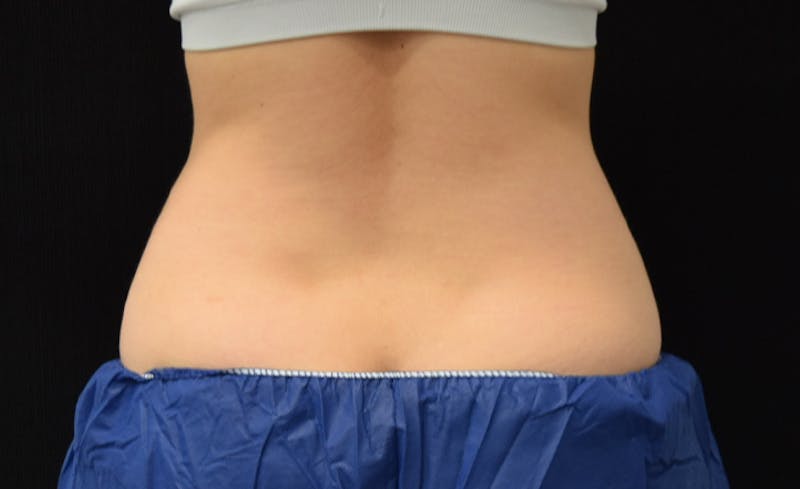 CoolSculpting Before & After Gallery - Patient 102583373 - Image 11