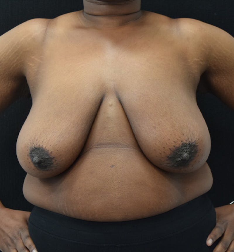 Breast Reduction Before & After Gallery - Patient 102583384 - Image 1