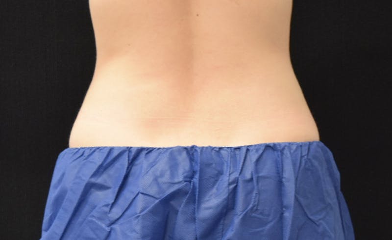 CoolSculpting Before & After Gallery - Patient 102583373 - Image 12