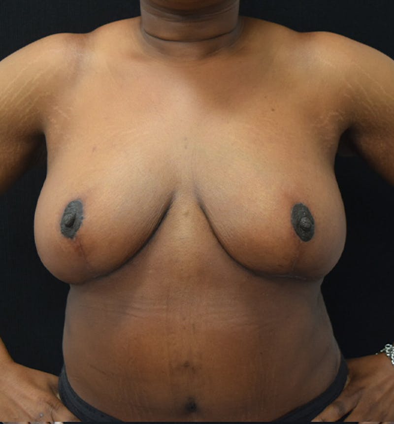 Breast Reduction Before & After Gallery - Patient 102583384 - Image 2