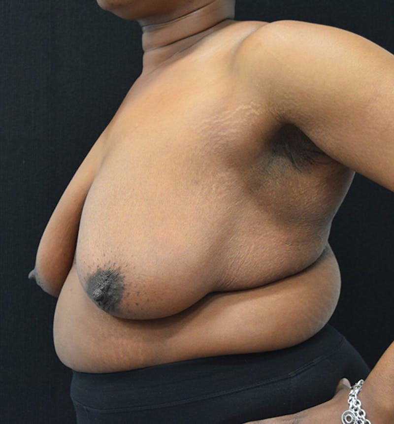 Breast Reduction Before & After Gallery - Patient 102583384 - Image 3