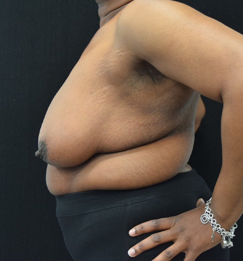 Breast Reduction Before & After Gallery - Patient 102583384 - Image 5