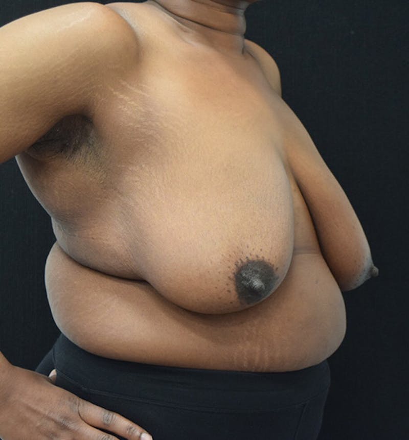 Breast Reduction Before & After Gallery - Patient 102583384 - Image 7